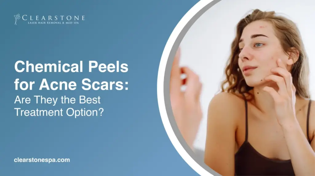 Chemical Peels for Acne Scars