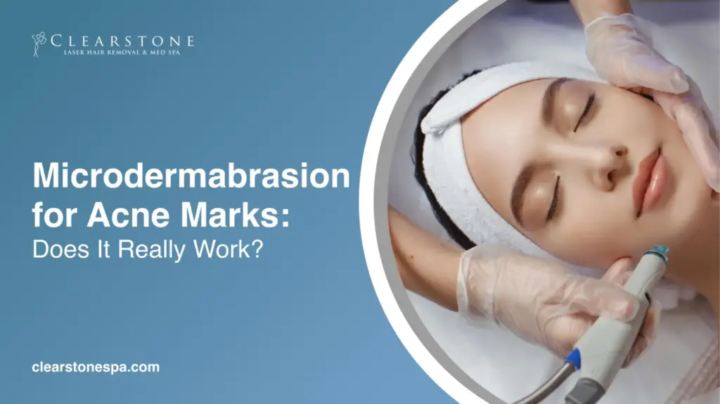 Microdermabrasion for Acne Marks