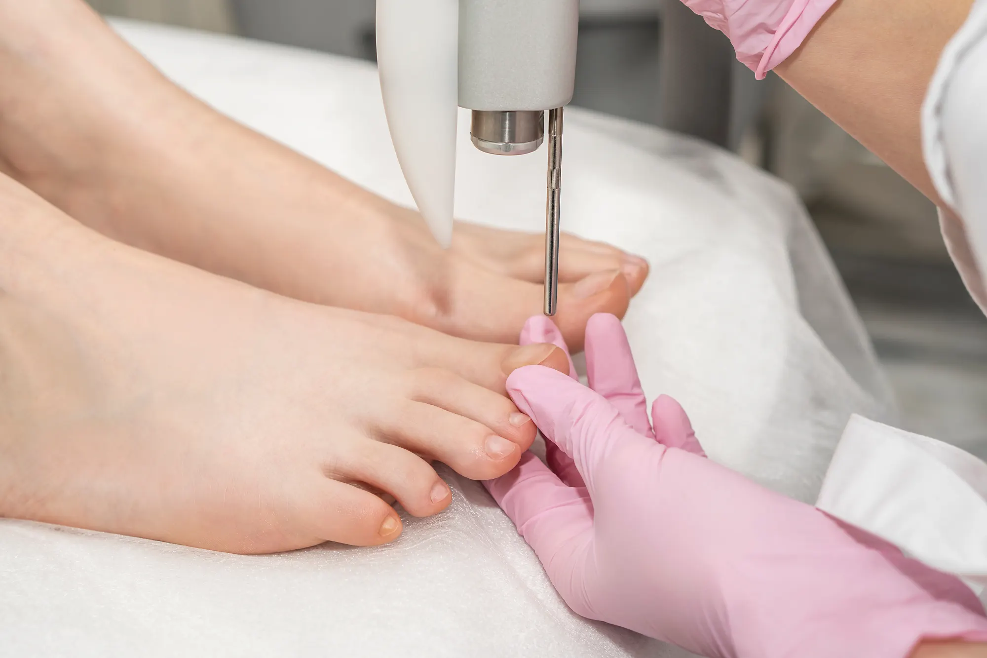 Nail Fungal