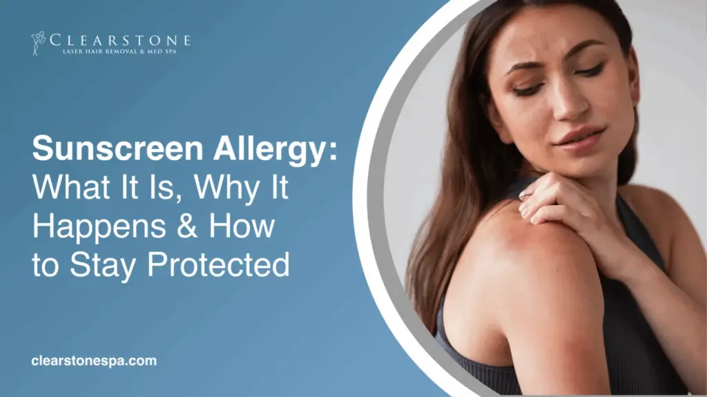 Sunscreen Allergy