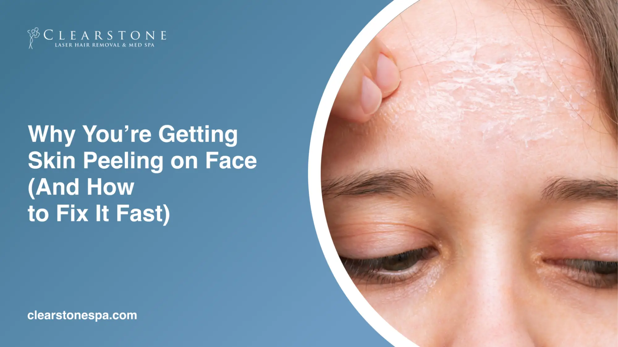 Skin Peeling